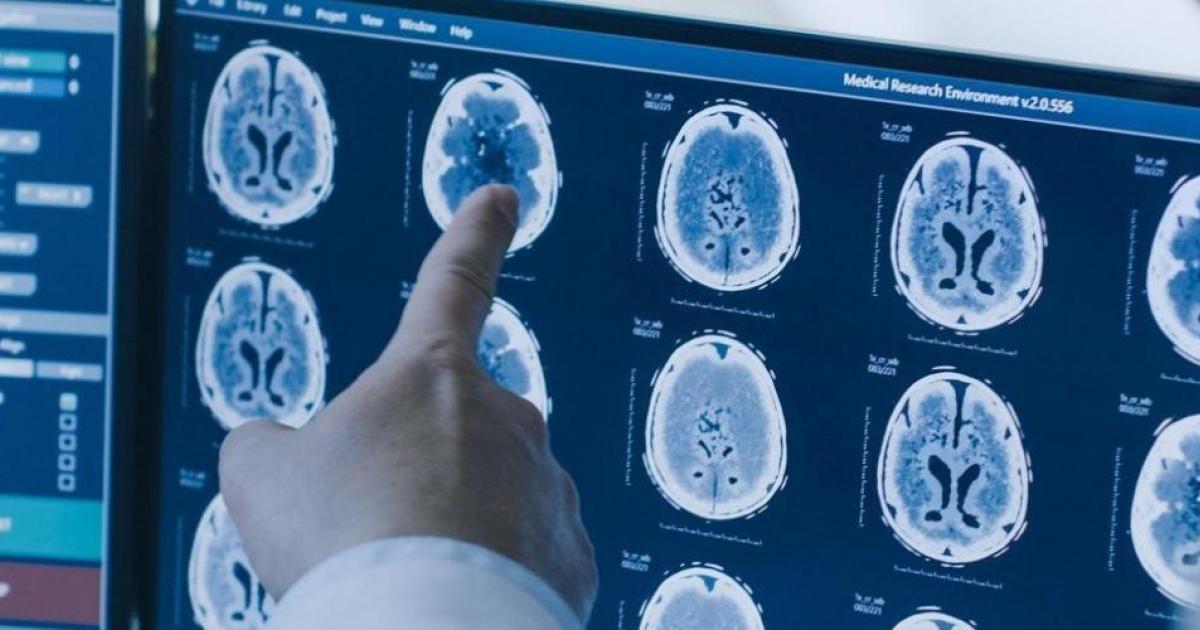 Les tumeurs cérébrales | GHU Paris psychiatrie & neurosciences